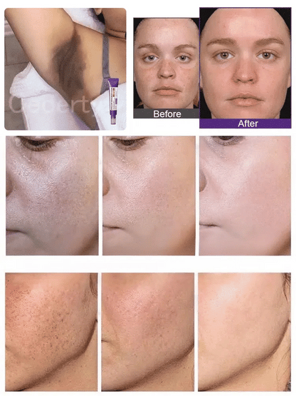 Highly effective whitening and spot-lightening cream
